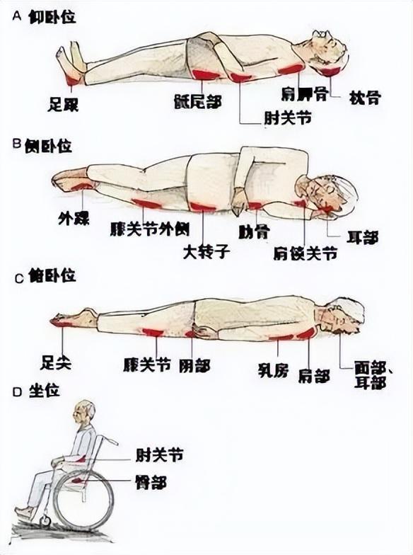 压疮预防与治疗，最新指南解读（2016版）